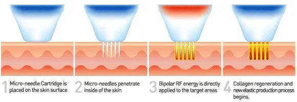 RF microneedling stages