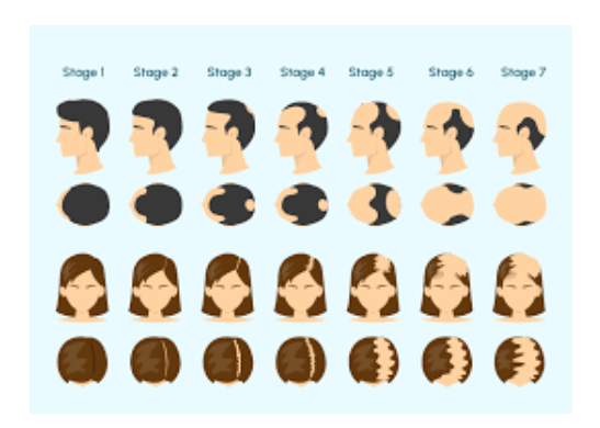 hair loss stages chart