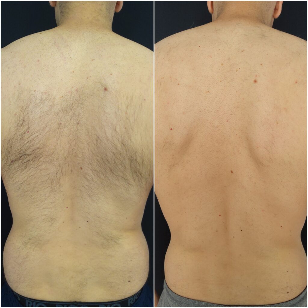 Comparison showing before and after results of male laser hair removal Auckland on the back using Beautilase’s Splendor X laser.