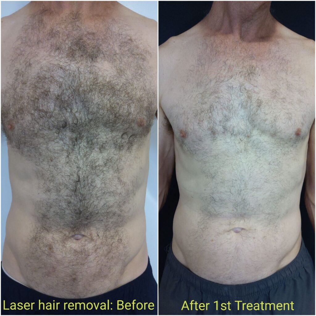 Comparison showing before and after results of male laser hair removal Auckland on the chest using Beautilase’s Splendor X laser.