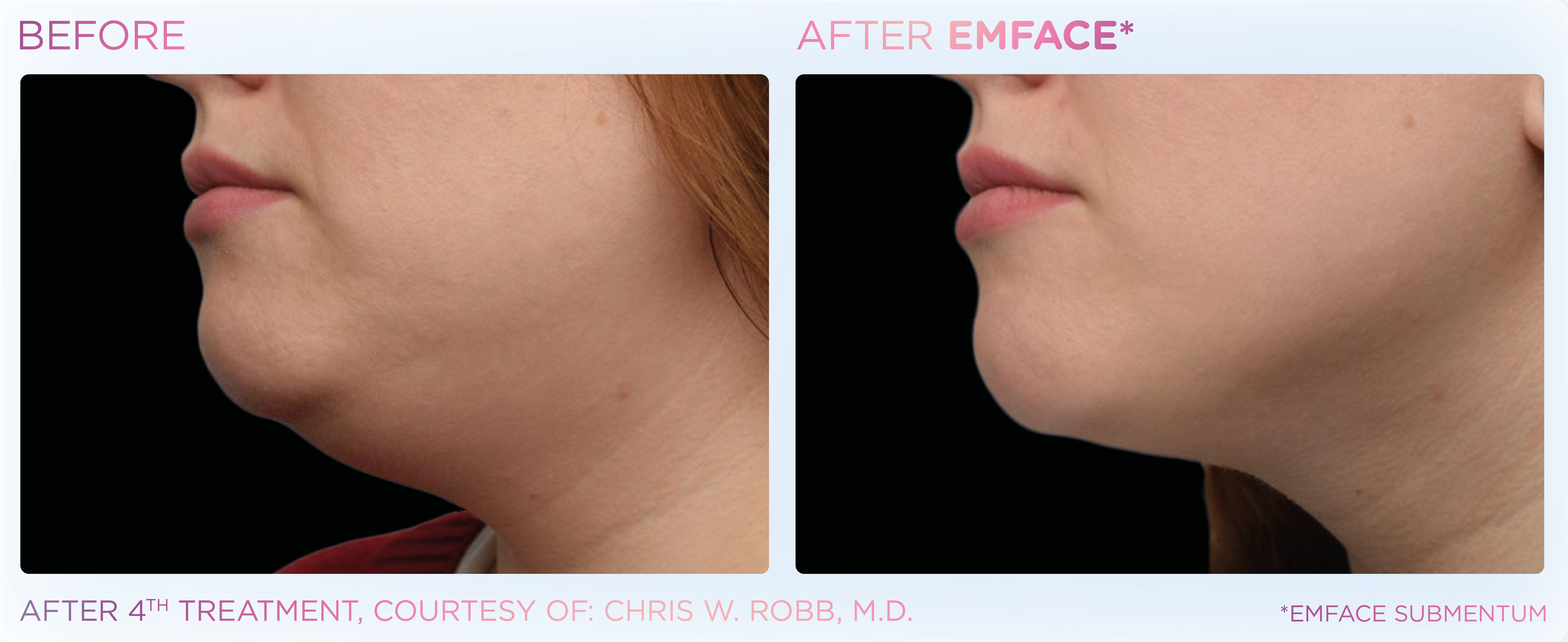 EMFACE before photos showing what a double chin removal nz can do.