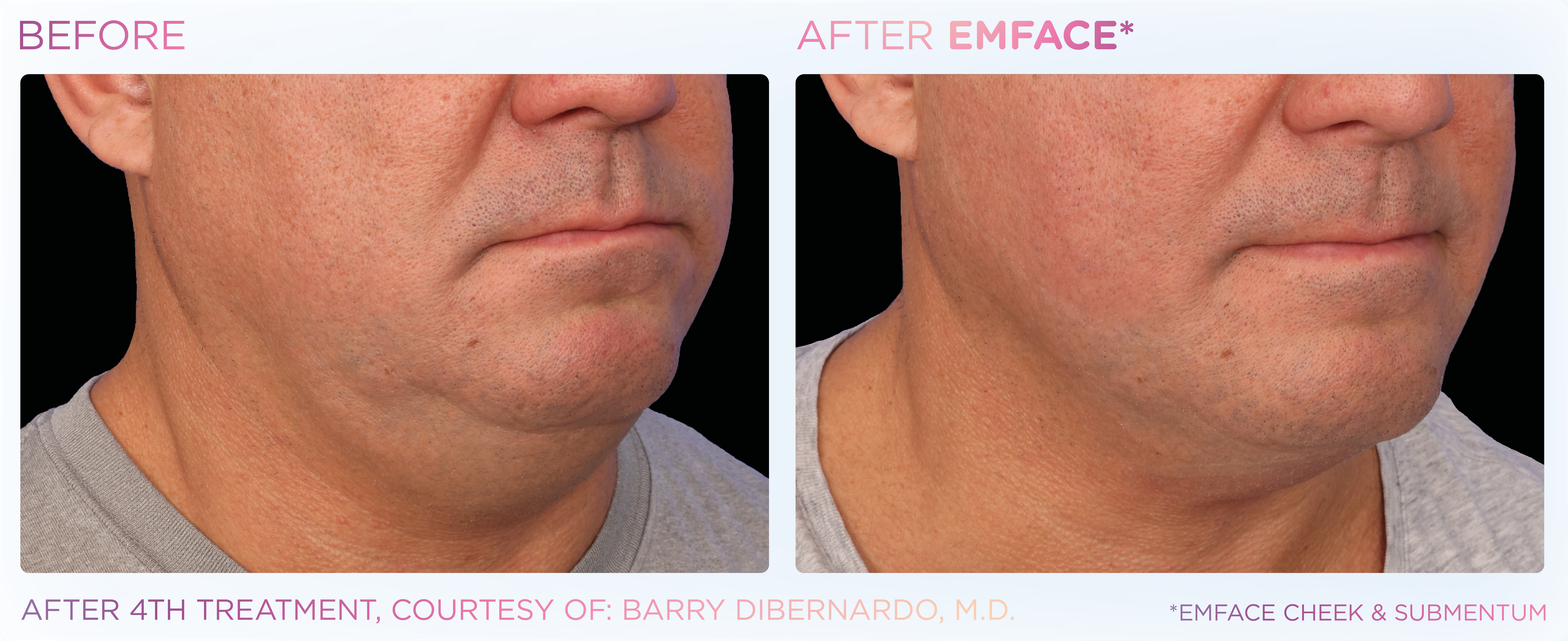 EMFACE before photos showing what a double chin removal nz can do.