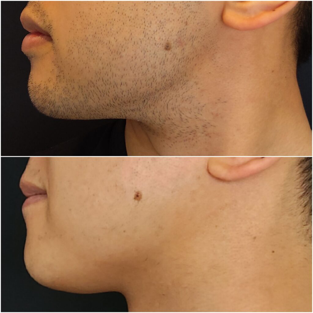 Comparison showing before and after results of male laser hair removal Auckland on facial hair using Beautilase’s Splendor X laser.